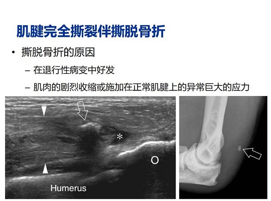 【经典超声书籍解读】肌肉骨胳超声诊断之肌腱完全撕裂和术后改变