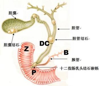 急性左上腹痛，当心急性胰腺炎