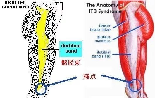 跑步虽好，但需警惕髂胫束综合征