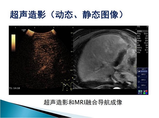 第三届中国超声造影大会病例大赛北医三院超声科获奖病例展示（一）