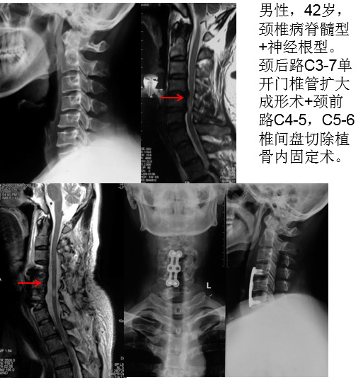 脊柱组典型病例 