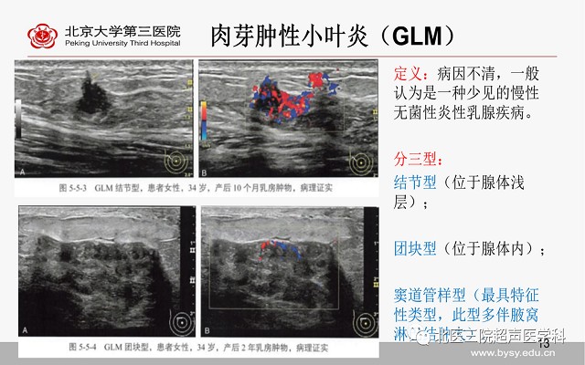 病例回顾之乳腺肉芽肿性小叶炎