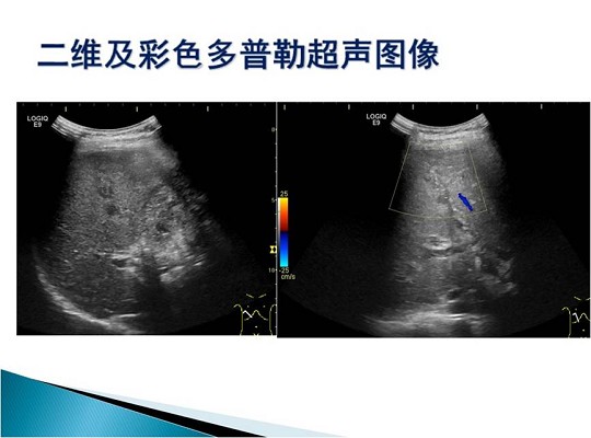 第三届中国超声造影大会病例大赛北医三院超声科获奖病例展示（一）