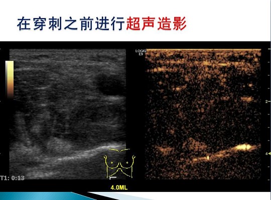 第三届中国超声造影大会病例大赛北医三院超声科获奖病例展示（四）