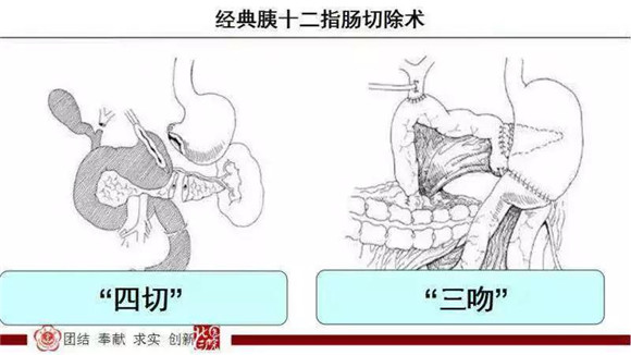 从“四切三吻合”到“一切一吻合” ——胰头部良性肿物切除新术式【2018 技术创新一等奖】