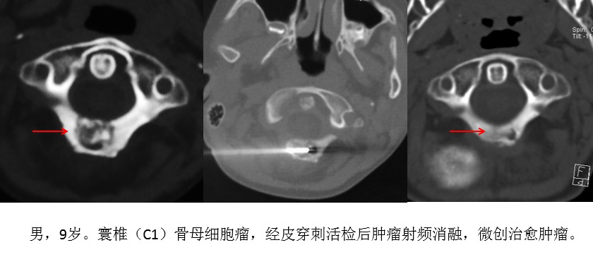 脊柱组典型病例 