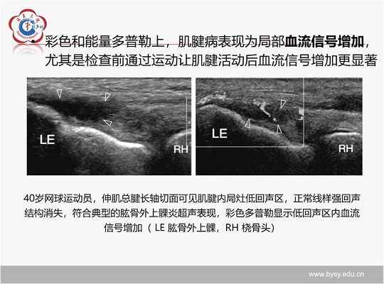 【经典超声书籍解读】肌肉骨胳超声诊断之肌腱病与部分撕裂