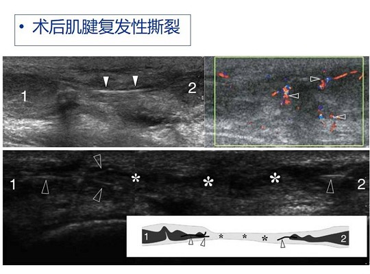 【经典超声书籍解读】肌肉骨胳超声诊断之肌腱完全撕裂和术后改变