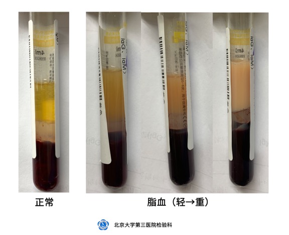 溶血、黄疸和脂血对生化项目的影响