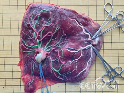 双胎贫血—红细胞增多序列胎盘图例
