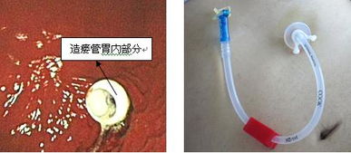 经皮内镜胃造瘘术后患者的家庭护理