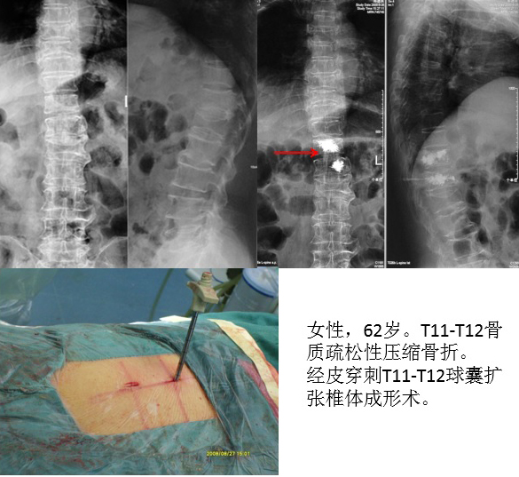 脊柱组典型病例 