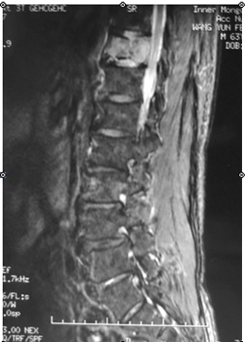 从3个病例谈脊柱原发肿瘤诊疗的特殊性