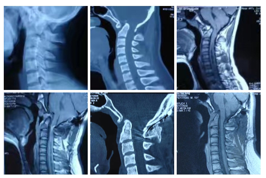 颅椎组典型病例