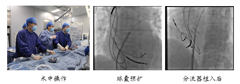 北京大学第三医院心血管内科成功完成首例心房分流器植入术