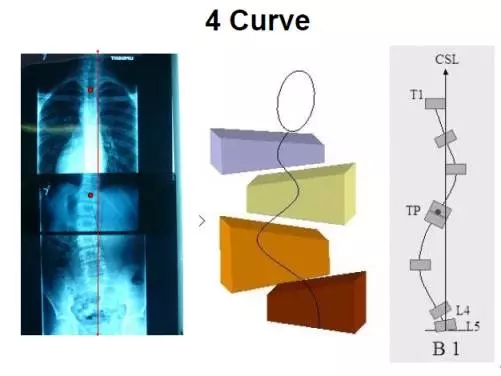 北医三院康复科引进Schroth三维脊柱侧弯治疗法治疗脊柱侧弯患者