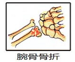 康复医学专家教您骨质疏松症的诊、疗、防!