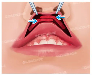 唇裂继发唇畸形之“口哨唇”