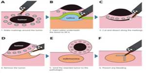 口袋法内镜黏膜下剥离术