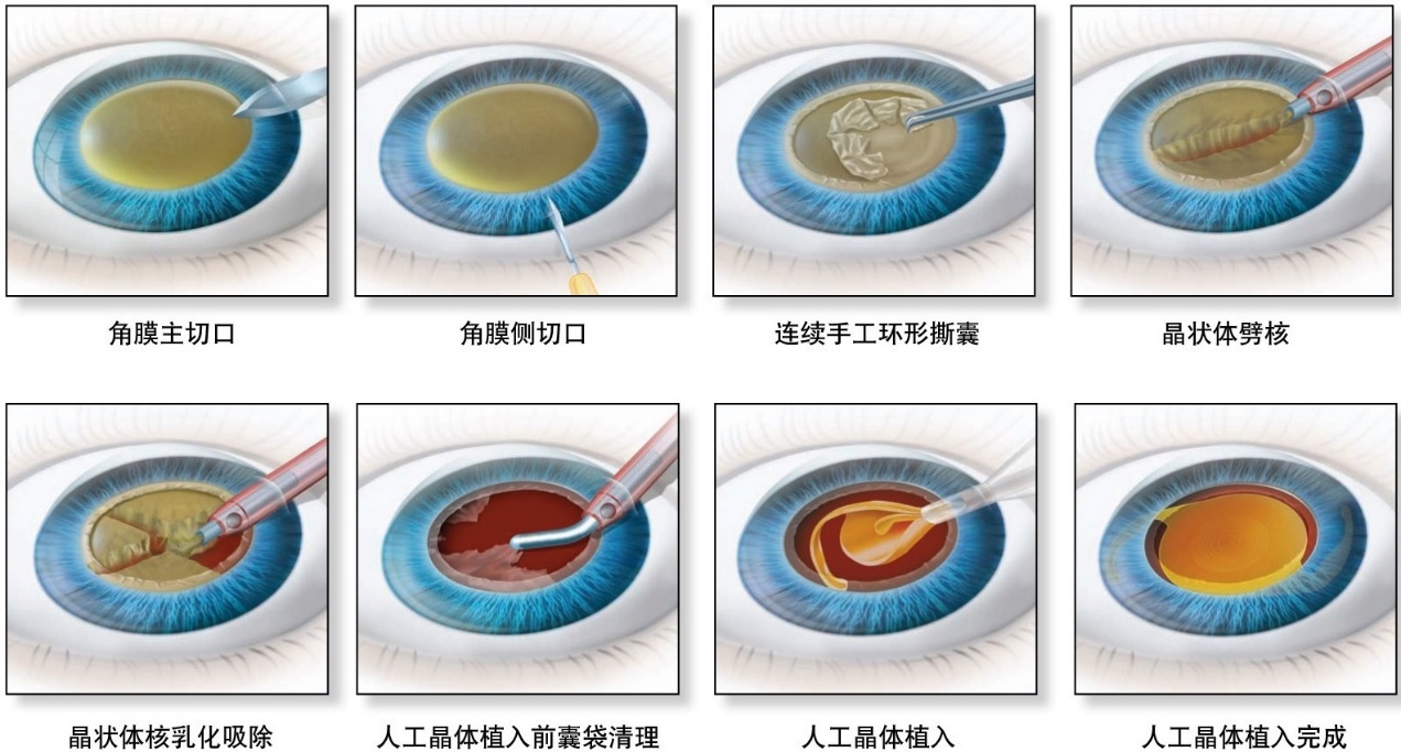 白内障必须成熟才可以做手术？