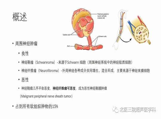 【经典超声书籍解读】周围神经肿瘤性病变(上)