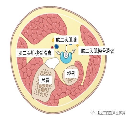 滑囊的超声评估-解剖及常见病变（二）