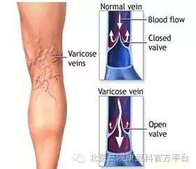 下肢静脉曲张术后康复