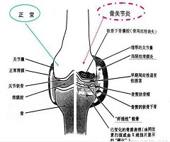 应对膝关节的“炎”重警告，康复医学专家给您支招！