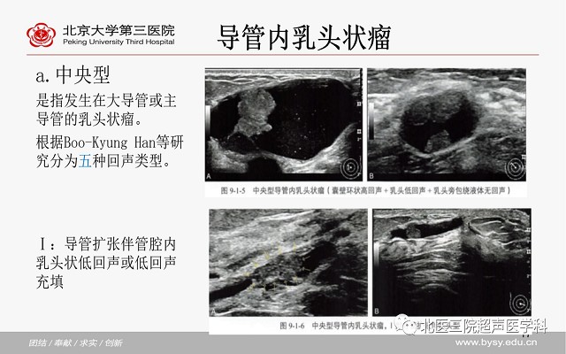 病例回顾与学习之乳腺导管内乳头状瘤