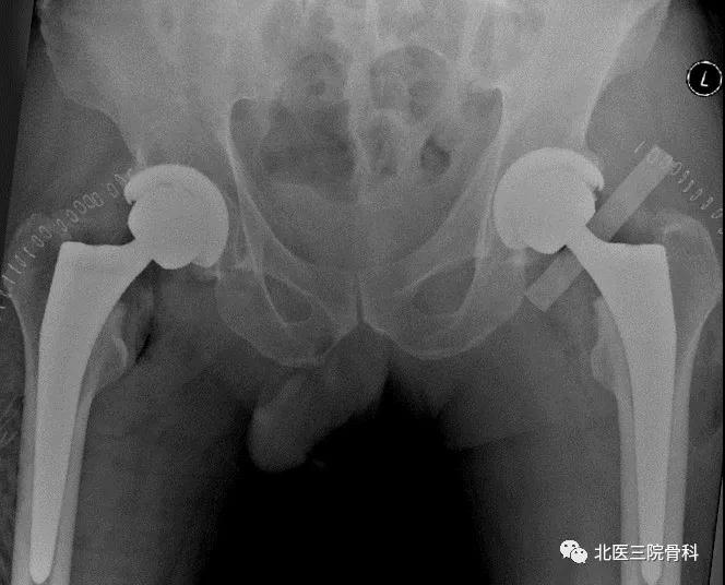 国际领先｜北京大学第三医院完成计算机导航辅助下合并严重髋臼侧骨缺损的髋关节翻修手术