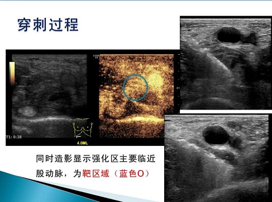 第三届中国超声造影大会病例大赛北医三院超声科获奖病例展示（四）