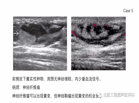 【经典超声书籍解读】周围神经肿瘤性病变(上)