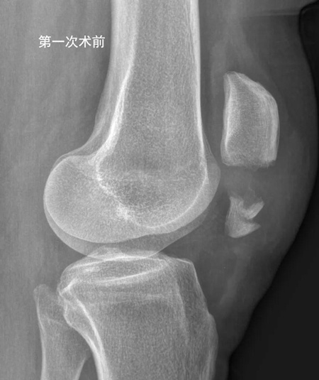 异形垫片，纵横连接——髌骨下极粉碎骨折的新选择