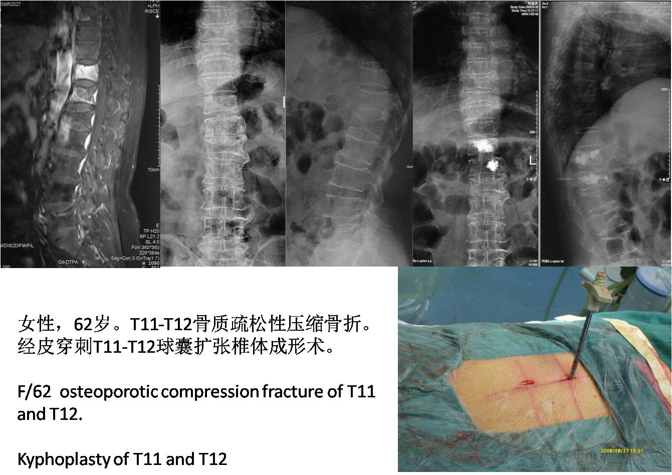 脊柱组典型病例 