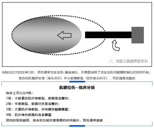 【经典超声书籍解读】肌肉拉伤及挫裂伤