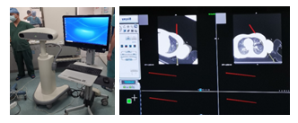 肿瘤放疗科成功为患者实施我院首例导航辅助3D打印共面模板CT引导下肺转移瘤微波消融技术