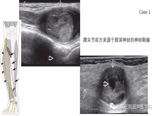 【经典超声书籍解读】周围神经肿瘤性病变(上)