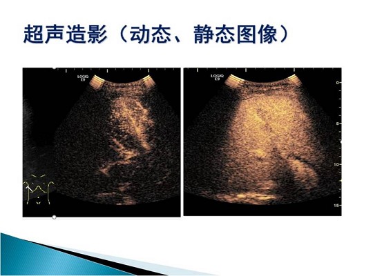 第三届中国超声造影大会病例大赛北医三院超声科获奖病例展示（一）