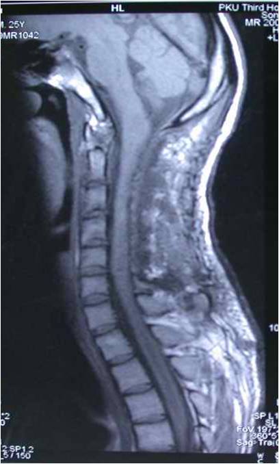 高颈段髓内肿瘤