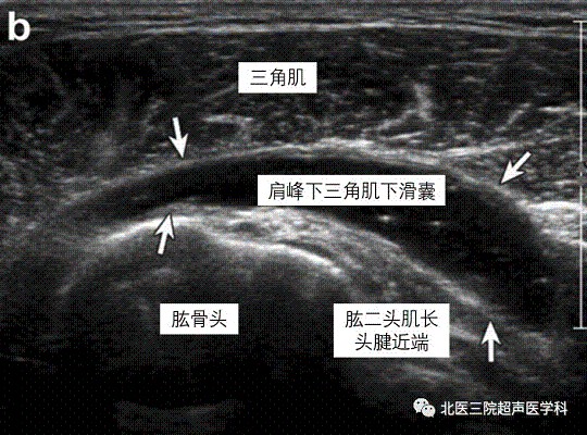 滑囊的超声评估-解剖及常见病变（一）