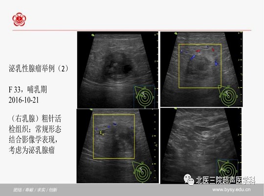 泌乳性腺瘤