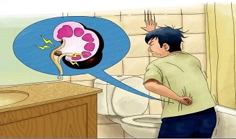 肾脏里“兴风作浪”的小石头怎么回事儿？