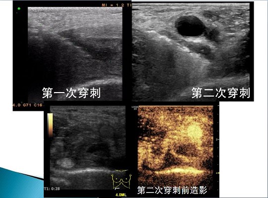 第三届中国超声造影大会病例大赛北医三院超声科获奖病例展示（五）