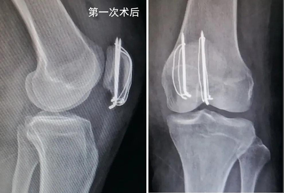 异形垫片，纵横连接——髌骨下极粉碎骨折的新选择