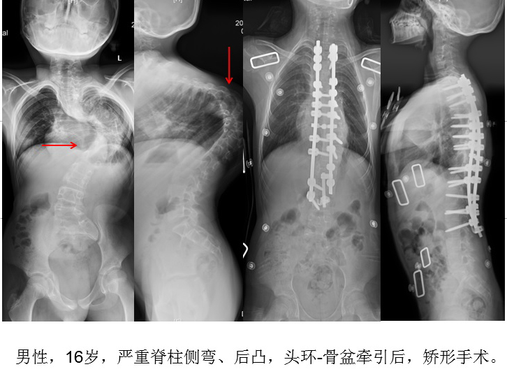 脊柱组典型病例 