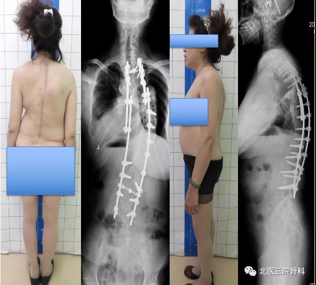 北京大学第三医院骨科脊柱畸形专业组正式成立