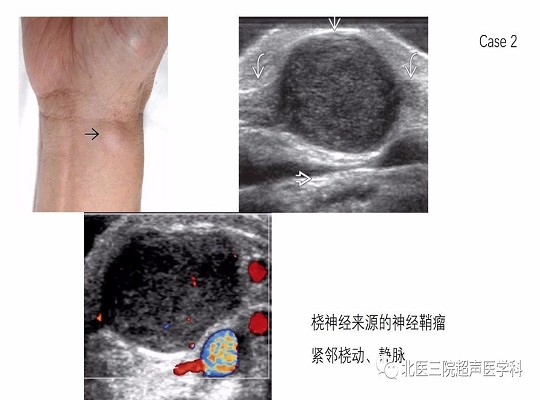 【经典超声书籍解读】周围神经肿瘤性病变(上)