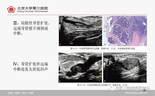 病例回顾与学习之乳腺导管内乳头状瘤