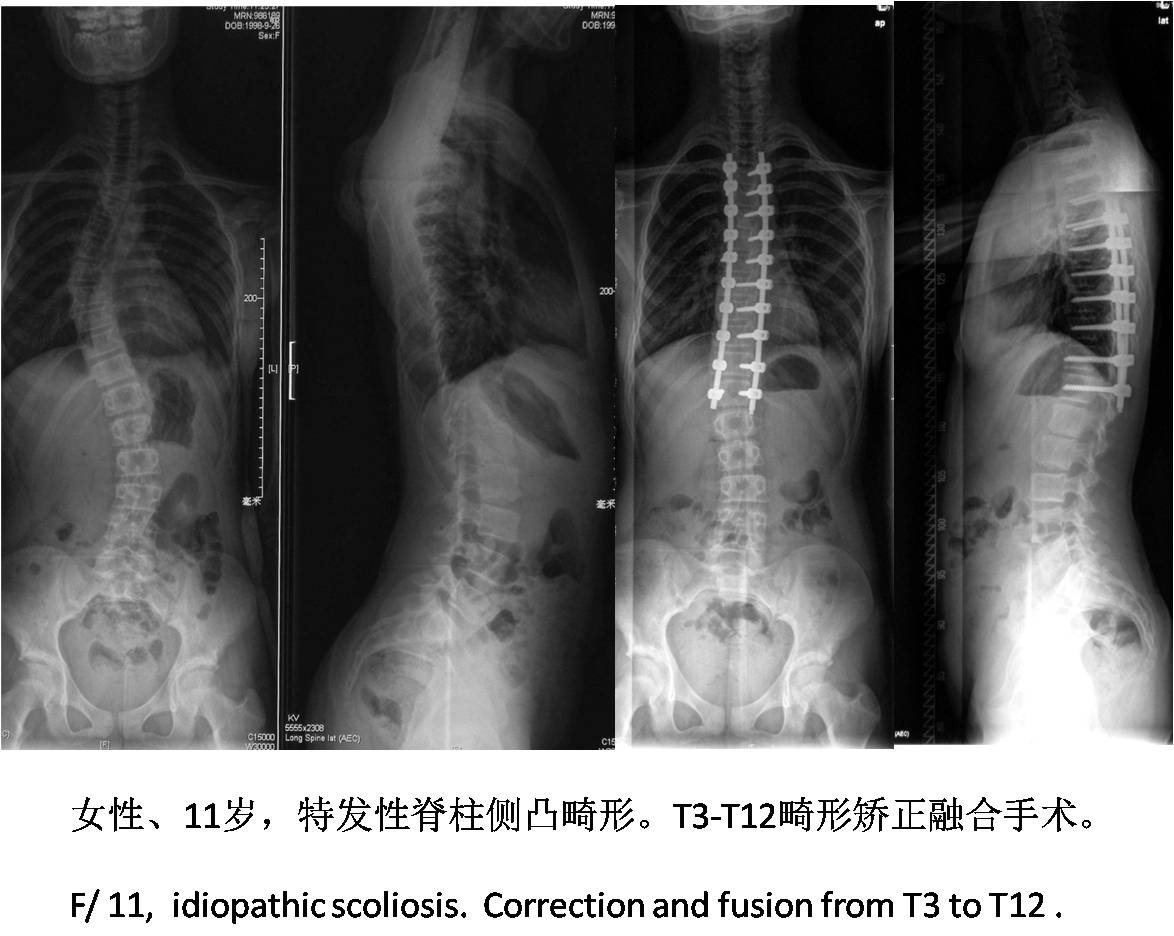 脊柱组典型病例 