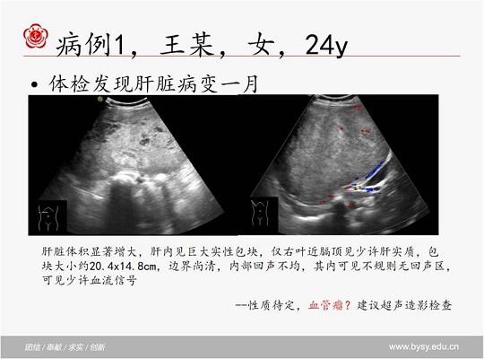 肝脏占位性病变之肝腺瘤